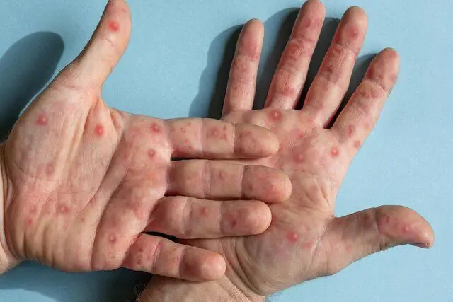 بڵاوبوونەوەی نەخۆشی ئاوڵەی مەیموون لە ئەفریقیا