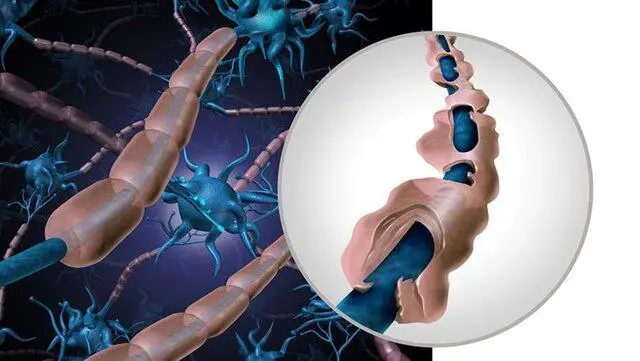 نەخۆشی ئێم ئێس کۆمەڵێک نیشانەی جیاوازی هەیە و ژنان زۆر زیاتر لە پیاوان تووشی ئێم ئێس دەبن.