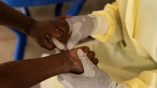 Maymun çiçegi salgini yayilmaya devam ediyor!