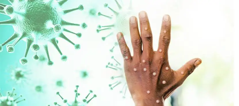 Hindistan'da maymun çiçegi süphesi!