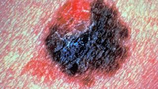 Yapay zeka deri kanserini insandan daha isabetli teshis etti