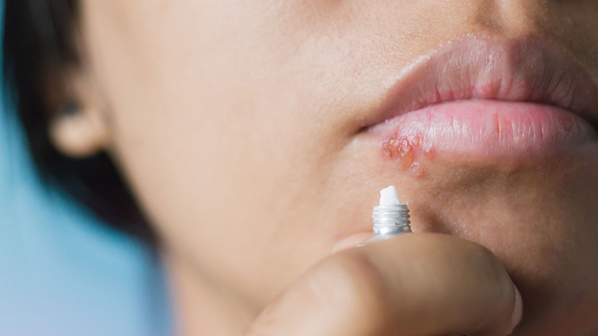 Alzheimer hastaligini tetikleyen sey herpes olabilir!