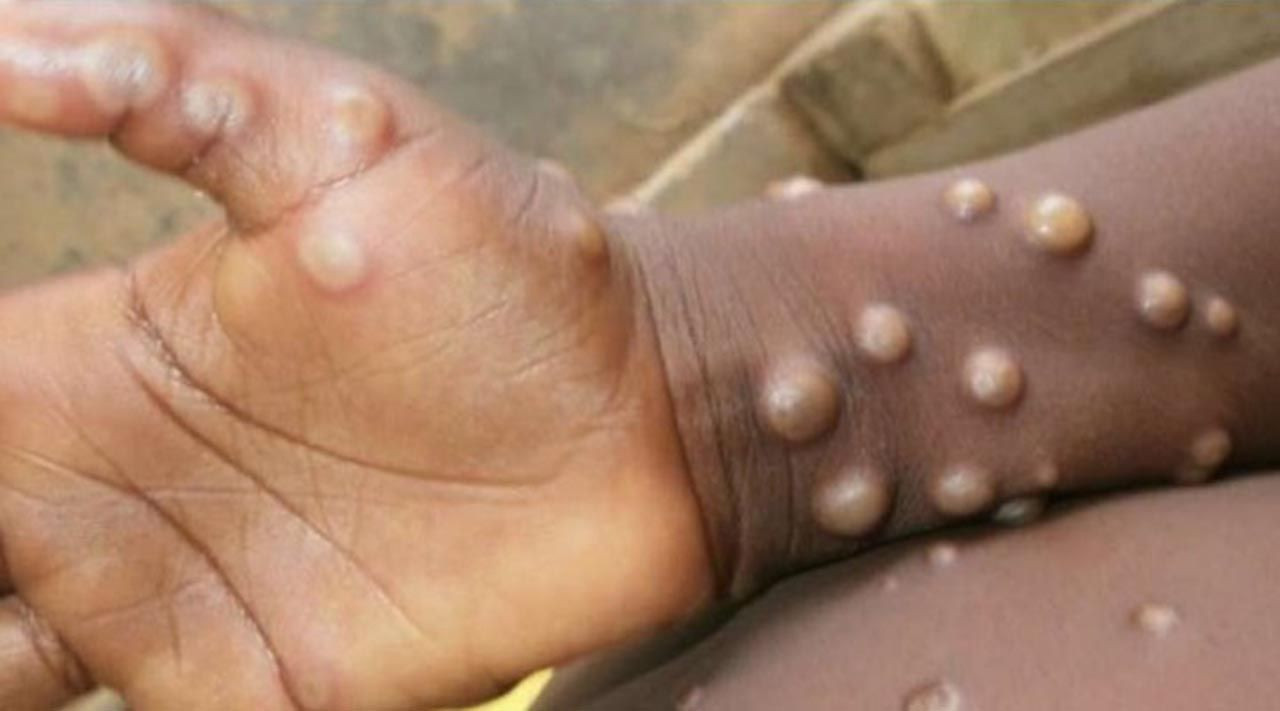 Sewba Monkeypoxê, li cîhanê belav dibe