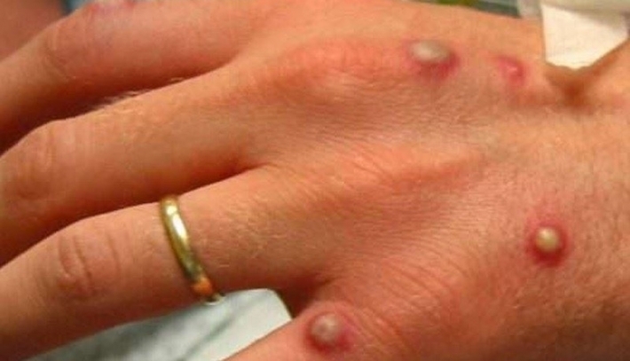 لێدوانی نوێی تەندروستی جیهانی لەبارەی ڤاکسینی بەکۆمەڵ دژی ئاوڵەی