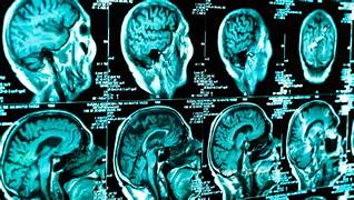 ژنێکی ڕووسی ٨٠ ساڵ بە دەرزییەک لە مێشکیدا ژیاوە